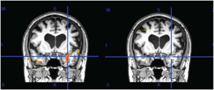 Brain Before and After NET Treatment Brain Before and After NET Treatment
